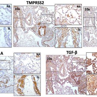 Ace Tmprss And Furin Expression On Small Airway Epithelium And