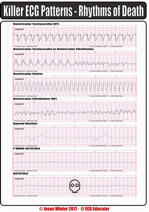 Ventricular tachycardia v tach or vt part 1 of 3 pathophysiology causes ...