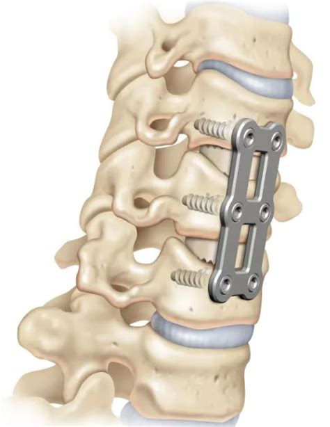 Cervical Spine Fusion 3 Level - tiktoktoktok