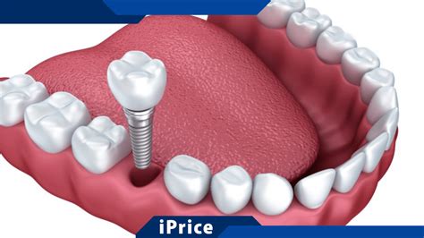 Combien coûte un dentier sur implants dentaires iPrice Le Vrai