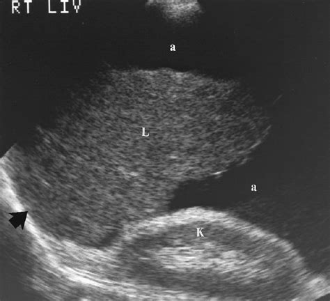 Wk 2 Liver Pathology Cirrhosis Abd 200 Mod 3 Ultrasound Pinterest