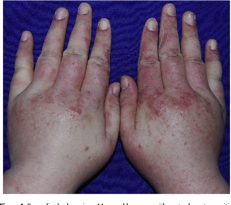 Figure From Severe Dermatomyositis With Pronounced Generalized