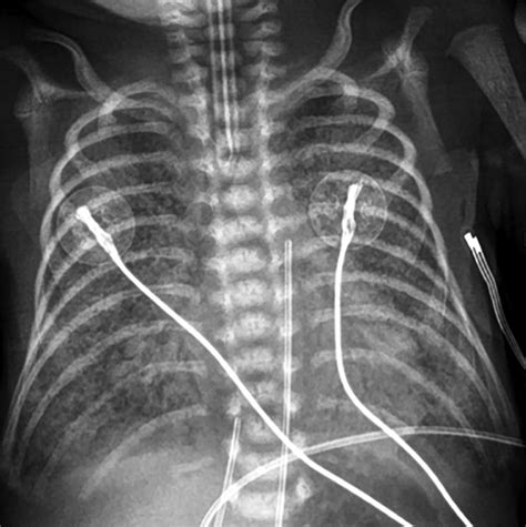 Neonatal Lung Disorders Pattern Recognition Approach To Diagnosis Ajr