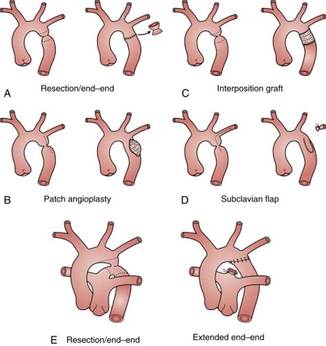 Aortic Coarctation And Interrupted Aortic Arch Thoracic Key