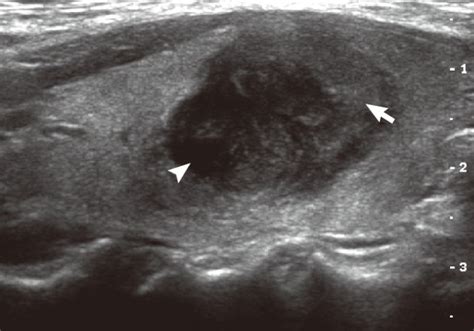 Ultrasonography Demonstrates A Mixed Echogenic Round Mass Which Download Scientific Diagram