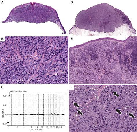 Spitzoid Melanomas With Nras Mutation A Low Power View Of Case