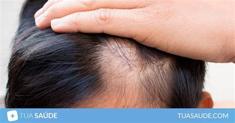 Alopecia o que é principais causas como identificar e tratamento