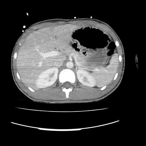 File Normal Dual Phase Trauma CT Chest Abdomen And Pelvis Radiopaedia