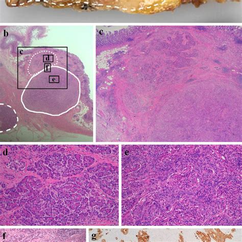 Figure2 A Macroscopic View Of The Tumor The Cut Surface Had A 2 Cm