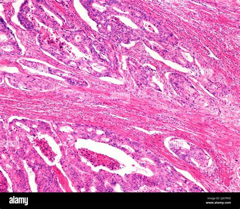 Adenocarcinoma In Human Colon Light Micrograph Stock Photo Alamy