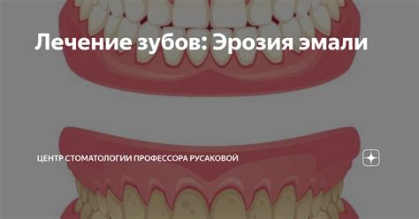 Лечение зубов: Эрозия эмали | Центр стоматологии Профессора Русаковой ...
