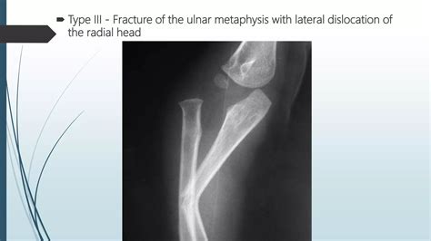 Fractures of radius and ulna . | PPT