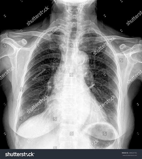 Chest Xray Scan Medical Diagnosis Stock Photo 248026792 | Shutterstock