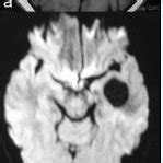 Lesion Patterns On Conventional MRI In Leukodystrophies And