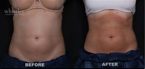 Coolsculpting Before And After Photos Incredible Outcomes