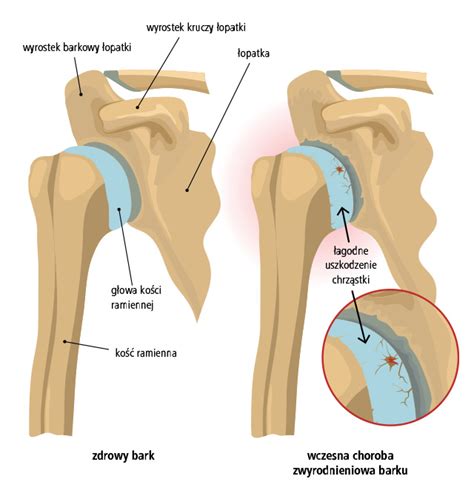 Zwyrodnienie Barku Objawy Rozpoznanie I Leczenie Ortopedia Mp Pl