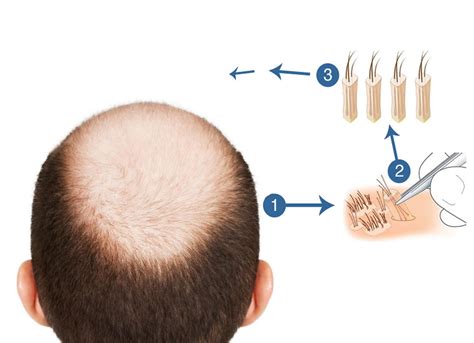 Fue Hair Transplant For Balding Hair Loss In Malaysia