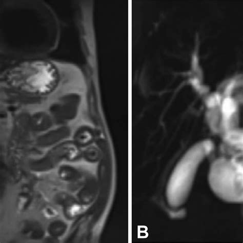 Cross Sectional Imaging Demonstrating Severe Intrahepatic A And