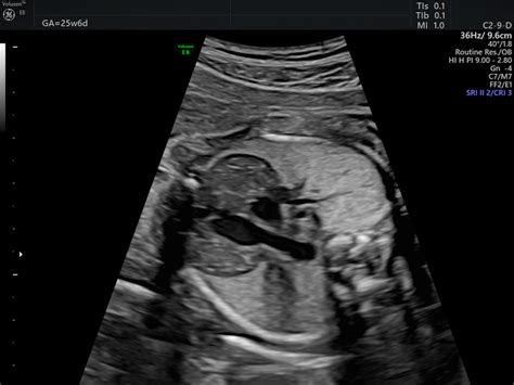 Fetal Cardiac Anomaly Scan Empowered Womens Health