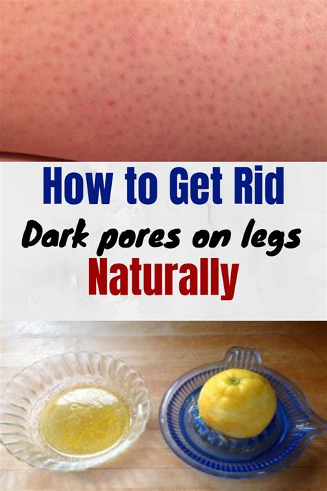 How To Get Rid Of Strawberry Legs Strawberry Legs Dark Pores Dark Leg Pores