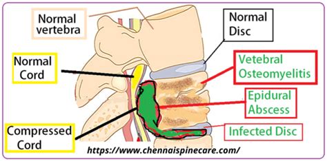 What Are The Symptoms And Treatments Of A Spinal Infections