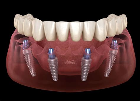 All On In Turkey Costs Dentatur Patient Reviews