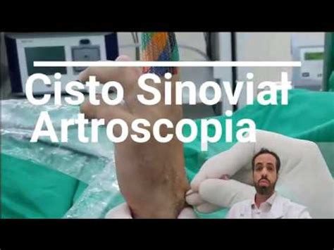 Cisto Sinovial Cirurgia Por V Deo Youtube