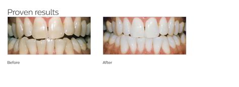 Your Guide to Teeth Whitening Blog - Harley St Smile