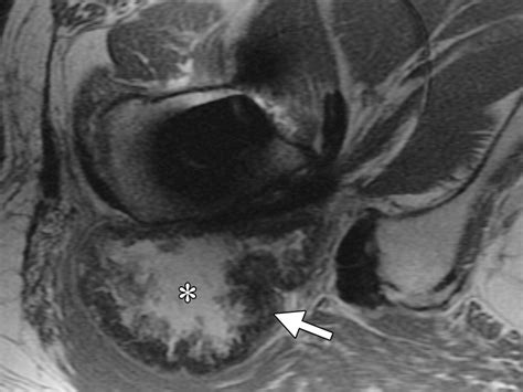 Mr Imaging Of Hip Arthroplasty Implants Radiographics