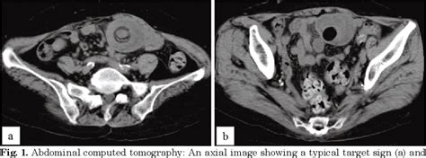 Figure 1 From A Case Of Spontaneously Reduced Ileoileal Intussusception