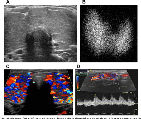 Graves Disease Thyroid Ultrasound