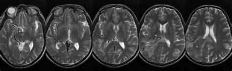 Dr Balaji Anvekar Frcr Secondary Intracerebral Hemorrhage