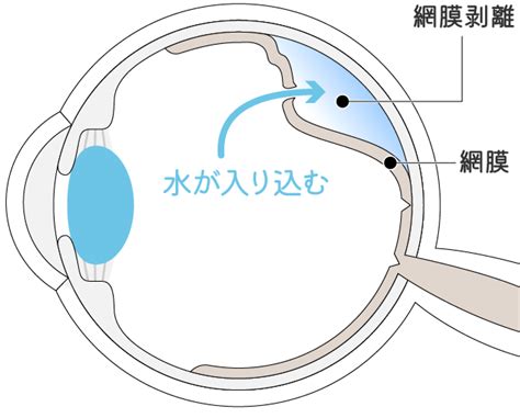 網膜剥離 目の病気について 山崎眼科