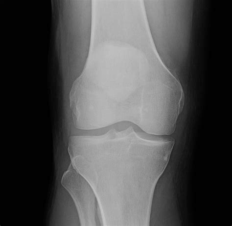 Medial Compartment Knee Arthritis