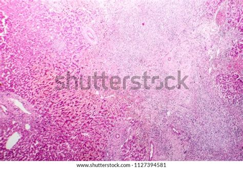 Histopathology Liver Abscess Light Micrograph Hematoxylin Stock Photo