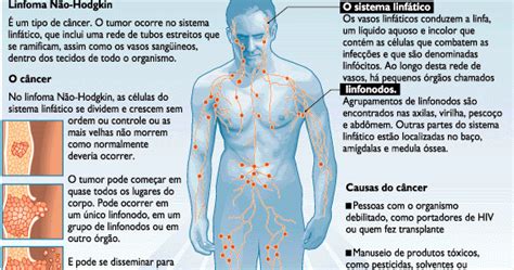 O Cancro Linfoma não Hodgkin