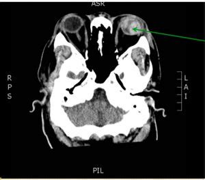 Globe Rupture Ct Annotated Jetem Jetem