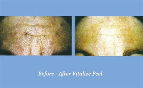 Vitalize Peel Before After Georgia Dermatology Center