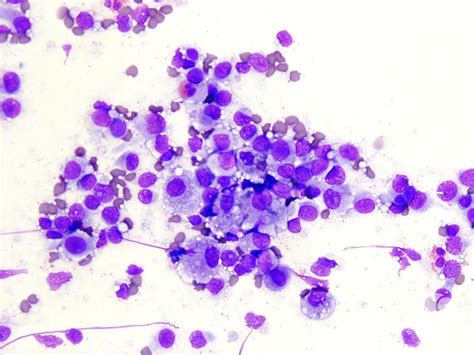 Langerhans Cell Histiocytosis Diff Quik Stained Touch Imprint