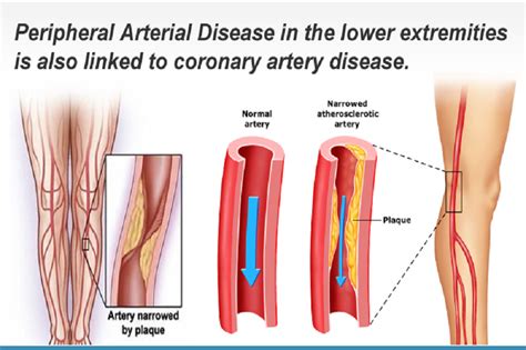 Pad Peripheral Artery Diseases Dr Srujal Shah