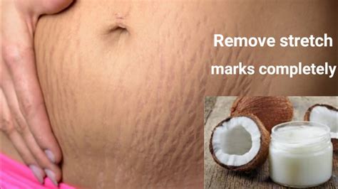 Remove Stretch Marks Completely In 7 Days Stretchmarksremoval