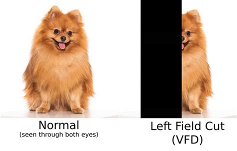 Distinguishing Between Visual Field Cut (VFD) vs. Inattention & Neglect ...