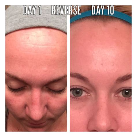 10 Days Into My Reverse Regimen With Rodan Fields Contact Me For