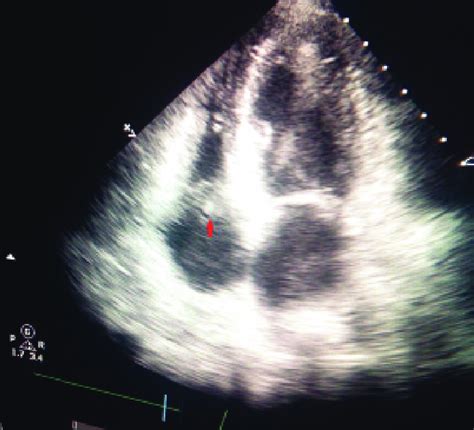 Echocardiography Showing Vegetation On Tricuspid Valve Red Arrow Download Scientific Diagram