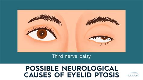 Neurological Causes Of Ptosis Myasthenia Gravis Horners Syndrome And Third Nerve Palsy Youtube