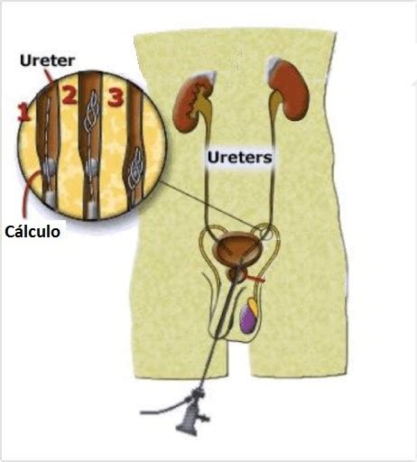 Litotricia Endoscopica Dr José Medina H