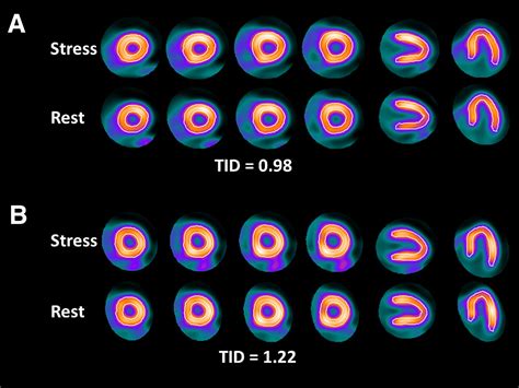 Transient Ischemic Dilation Ratio In 82rb Pet Myocardial Perfusion