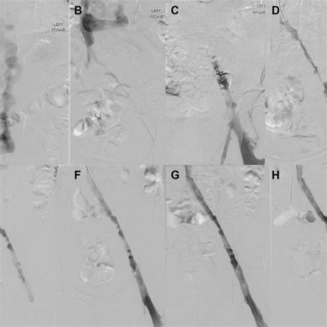 Images From Angiography Initial Angiography Showing The Patients