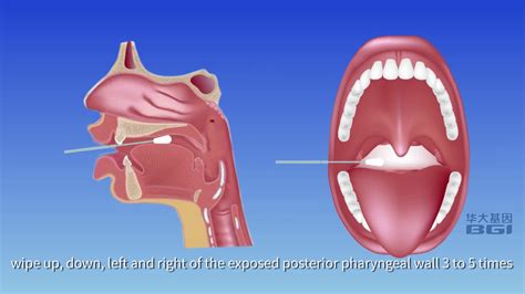 Dutch Instruction Of Oropharyngeal Swab Self Sampling Kit For 2019