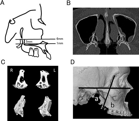 Influence Of The Anatomical Form Of The Posterior Maxilla On The